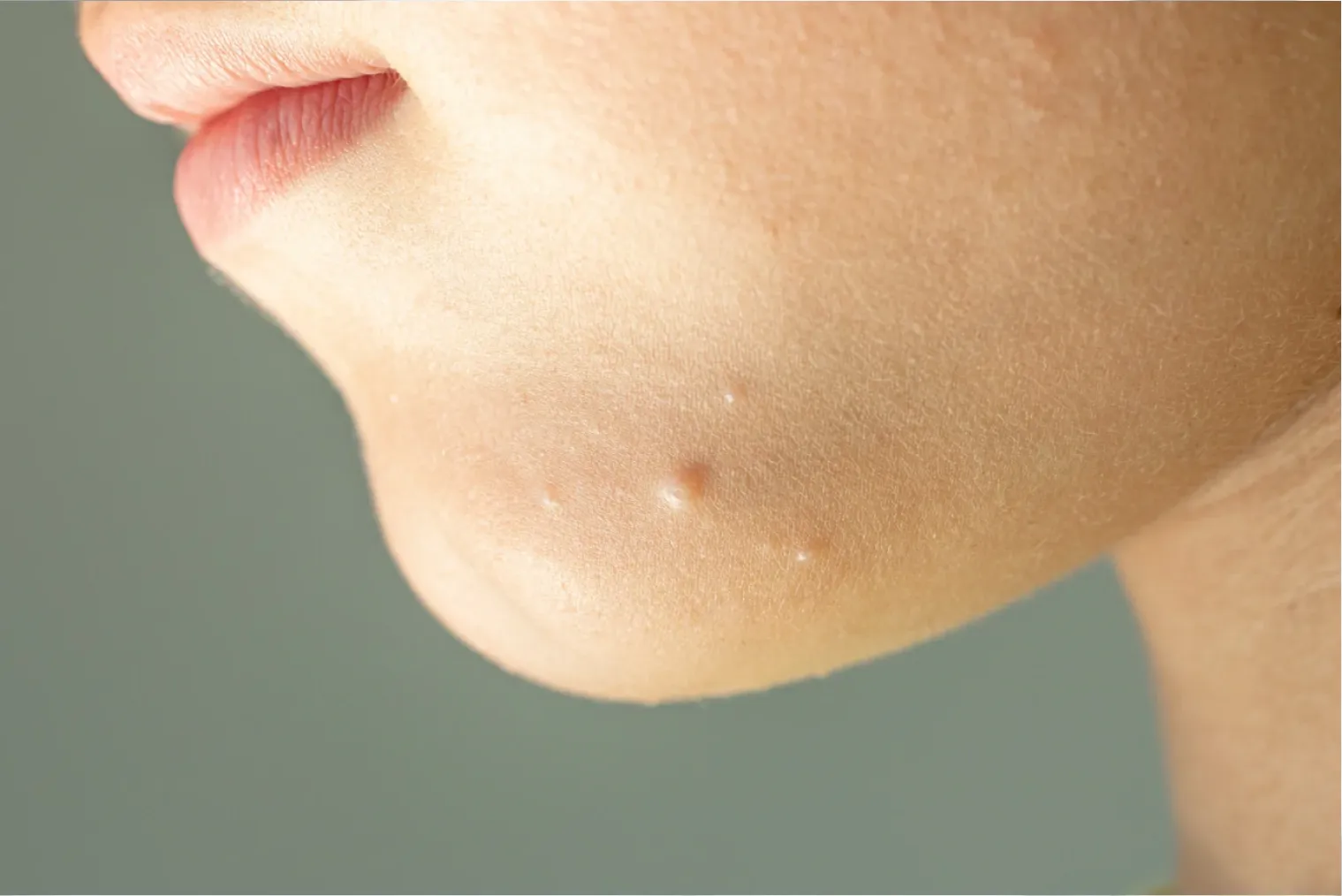 Molluscum Contagiosum Treatment in TX | Evolve Dermatology