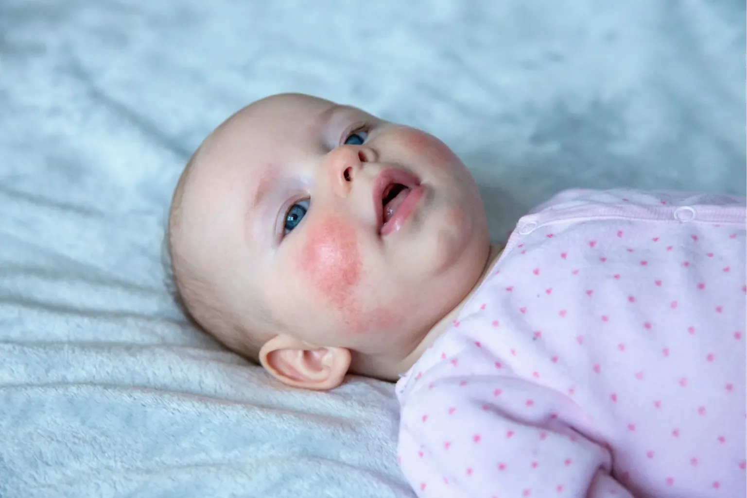 Pediatric Dermatology in Forney & Plano, TX | Evolve Dermatology