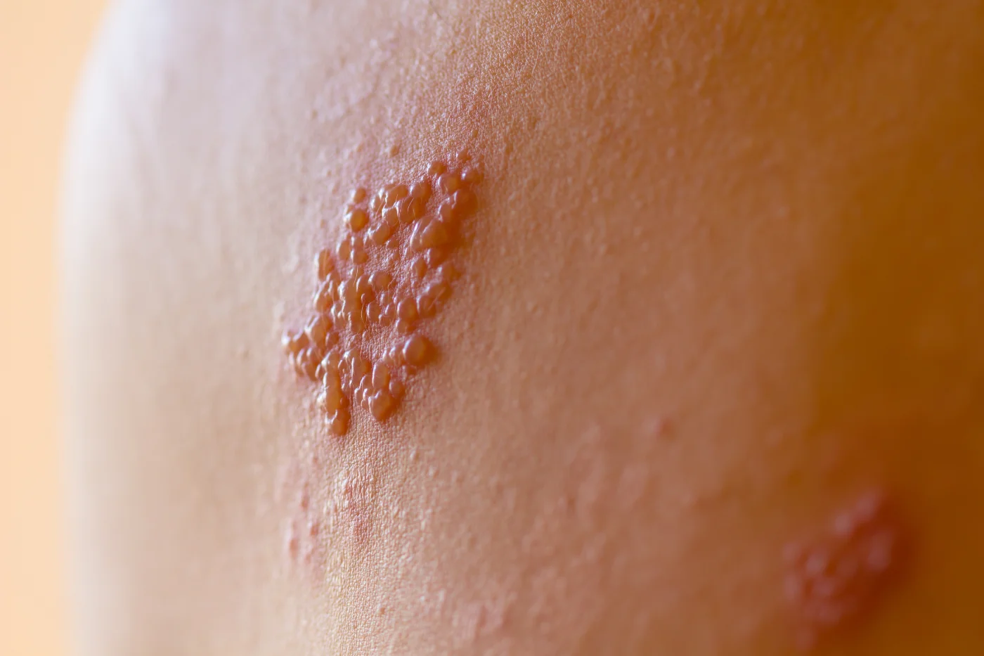 glutathione and shingles Varicella (Shingles) Shingles. Yikes! Who needs Valtrex?Benton