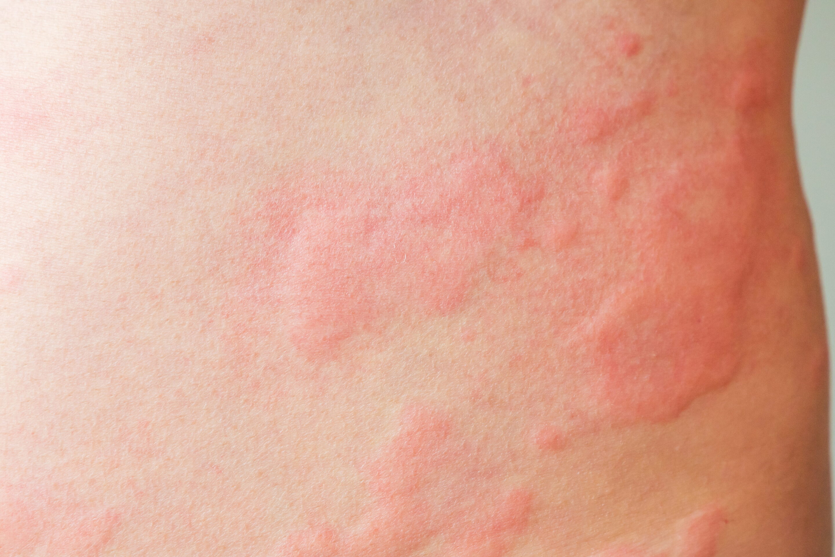 Skin allergy rash dermatitis texture close up background Skin allergy rash dermatitis texture close up background