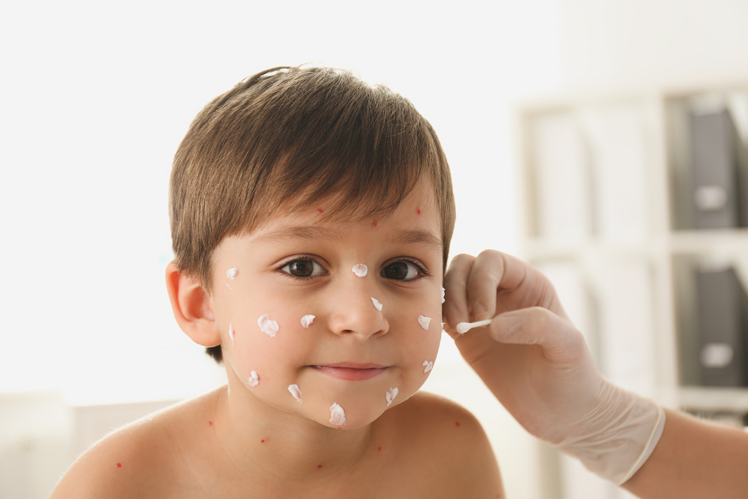 Doctor applying cream onto skin of little boy with chickenpox in clinic Doctor applying cream onto skin of little boy with chickenpox in clinic